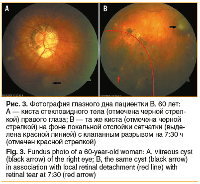 Рис. 3. Фотография глазного дна пациентки В. 60 лет: А — киста стекловидного тела (отмечена черной стрел- кой) правого глаза; В — та же киста (отмечена черной стрелкой) на фоне локальной отслойки сетчатки (выде- лена красной линией) с клапанным разрывом н