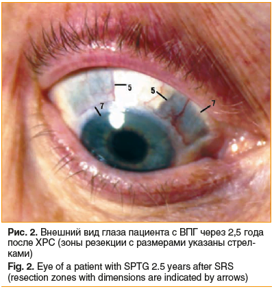 Рис. 2. Внешний вид глаза пациента с ВПГ через 2,5 года после ХРС (зоны резекции с размерами указаны стрел- ками) Fig. 2. Eye of a patient with SPTG 2.5 years after SRS (resection zones with dimensions are indicated by arrows)