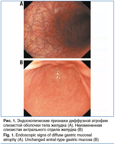 Рис. 1. Эндоскопические признаки диффузной атрофии слизистой оболочки тела желудка (А). Неизмененная слизистая антрального отдела желудка (В) Fig. 1. Endoscopic signs of diffuse gastric mucosal atrophy (A). Unchanged antral-type gastric mucosa (B)