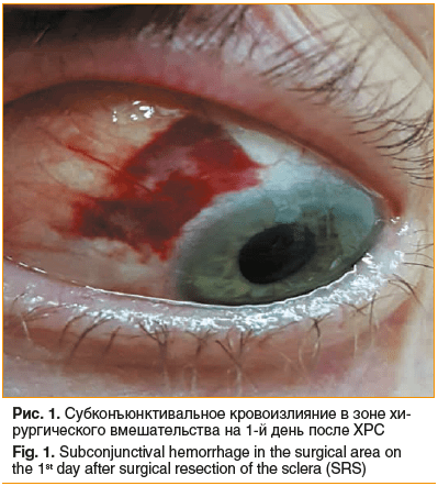 Рис. 1. Субконъюнктивальное кровоизлияние в зоне хи- рургического вмешательства на 1-й день после ХРС Fig. 1. Subconjunctival hemorrhage in the surgical area on the 1st day after surgical resection of the sclera (SRS)