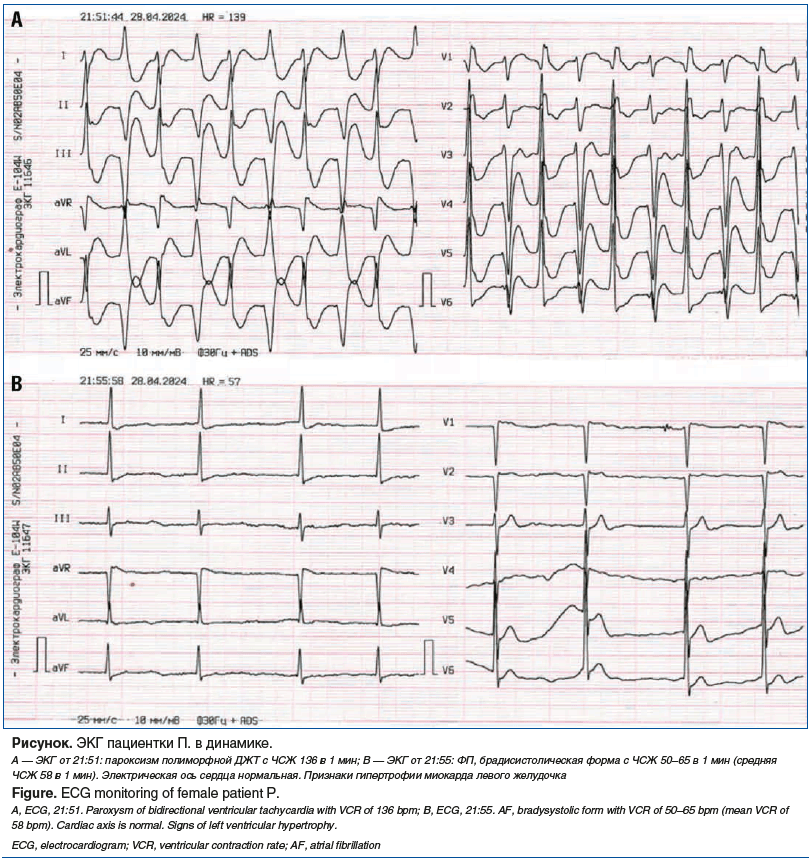 Рисунок. ЭКГ пациентки П. в динамике.
