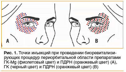 Рис. 1. Точки инъекций при проведении биоревитализи- рующих процедур периорбитальной области препаратами ГК-Мg (фиолетовый цвет) и ПДРН (оранжевый цвет) (A), ГК (черный цвет) и ПДРН (оранжевый цвет) (B)