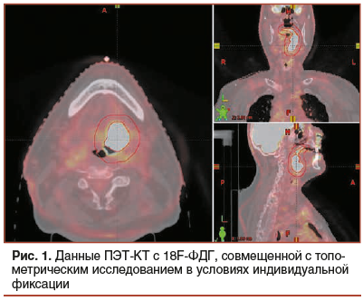 Рис. 1. Данные ПЭТ-КТ с 18F-ФДГ, совмещенной с топо- метрическим исследованием в условиях индивидуальной фиксации
