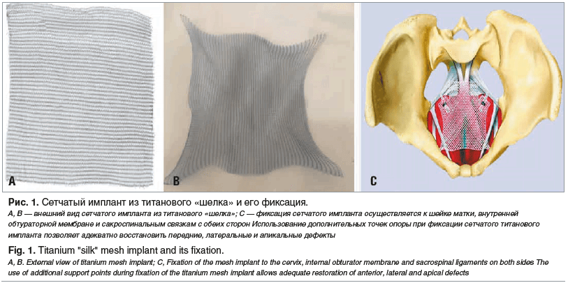 Рис. 1. Сетчатый имплант из титанового «шелка» и его фиксация. А, В — внешний вид сетчатого импланта из титанового «шелка»; С — фиксация сетчатого импланта осуществляется к шейке матки, внутренней обтураторной мембране и сакроспинальным связкам с обеих ст