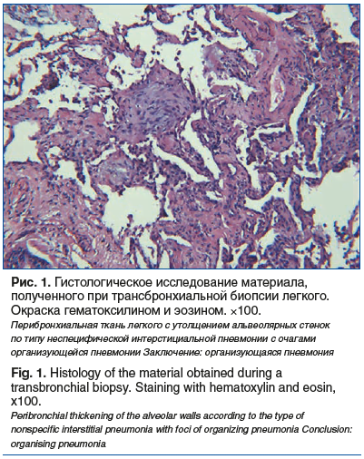 Рис. 1. Гистологическое исследование материала, полученного при трансбронхиальной биопсии легкого. Окраска гематоксилином и эозином. ×100. Перибронхиальная ткань легкого с утолщением альвеолярных стенок по типу неспецифической интерстициальной пневмонии с
