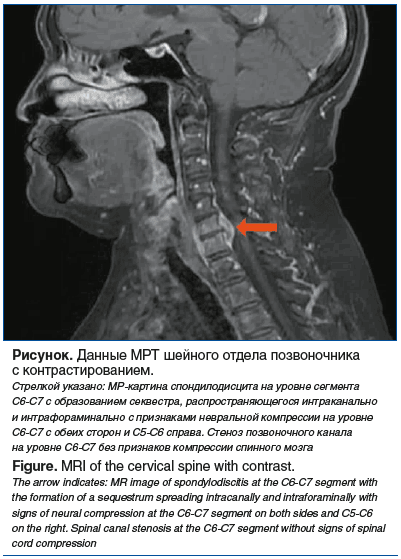 Рисунок. Данные МРТ шейного отдела позвоночника с контрастированием. Стрелкой указано: МР-картина спондилодисцита на уровне сегмента С6-С7 с образованием секвестра, распространяющегося интраканально и интрафораминально с признаками невральной компрессии н