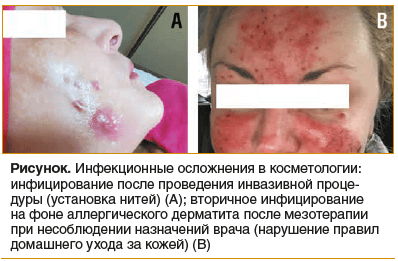 Рисунок. Инфекционные осложнения в косметологии: инфицирование после проведения инвазивной проце- дуры (установка нитей) (А); вторичное инфицирование на фоне аллергического дерматита после мезотерапии при несоблюдении назначений врача (нарушение правил до