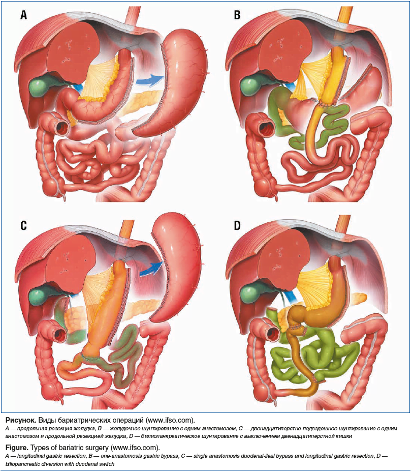 Рисунок. Виды бариатрических операций (www.ifso.com). А — продольная резекция желудка, B — желудочное шунтирование с одним анастомозом, C — двенадцатиперстно-подвздошное шунтирование с одним анастомозом и продольной резекцией желудка, D — билиопанкреатиче