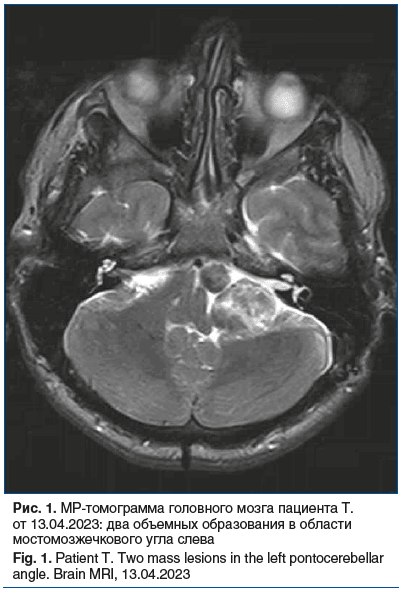 Рис. 1. МР-томограмма головного мозга пациента Т. от 13.04.2023: два объемных образования в области мостомозжечкового угла слева Fig. 1. Patient T. Two mass lesions in the left pontocerebellar angle. Brain MRI, 13.04.2023