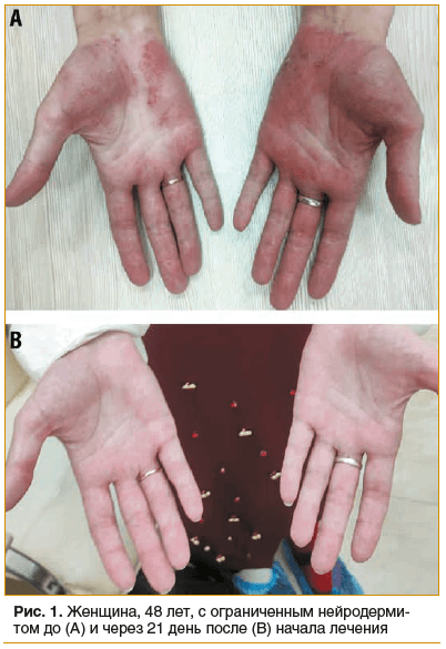 Рис. 1. Женщина, 48 лет, с ограниченным нейродерми- том до (А) и через 21 день после (В) начала лечения