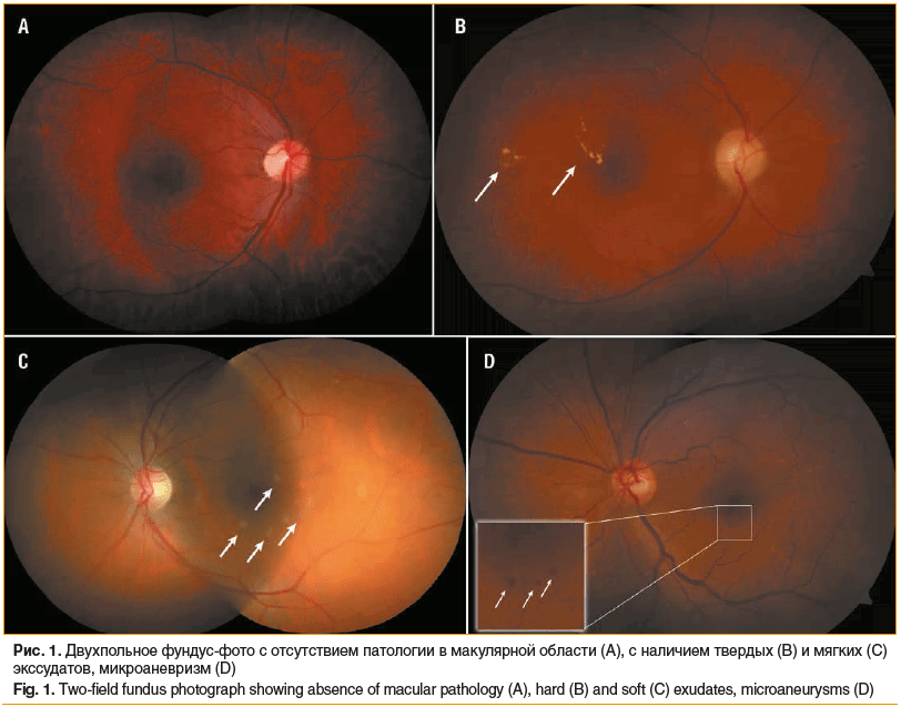 Рис. 1. Двухпольное фундус-фото с отсутствием патологии в макулярной области (A), с наличием твердых (B) и мягких (C) экссудатов, микроаневризм (D) Fig. 1. Two-field fundus photograph showing absence of macular pathology (A), hard (B) and soft (C) exudate