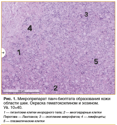 Рис. 1. Микропрепарат панч-биоптата образования кожи области шеи. Окраска гематоксилином и эозином.