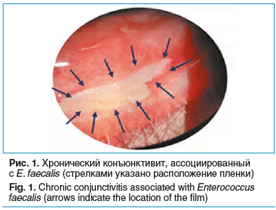 Рис. 1. Хронический конъюнктивит, ассоциированный с E. faecalis (стрелками указано расположение пленки) Fig. 1. Chronic conjunctivitis associated with Enterococcus faecalis (arrows indicate the location of the film)