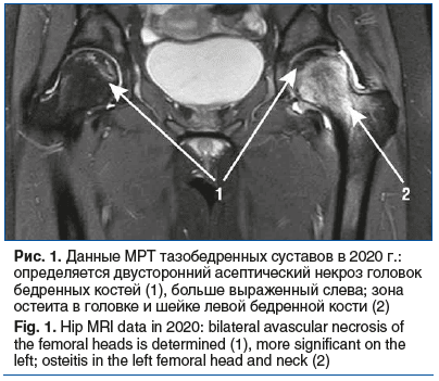 Рис. 1. Данные МРТ тазобедренных суставов в 2020 г.: определяется двусторонний асептический некроз головок бедренных костей (1), больше выраженный слева; зона остеита в головке и шейке левой бедренной кости (2) Fig. 1. Hip MRI data in 2020: bilateral avas