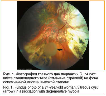 Рис. 1. Фотография глазного дна пациентки С. 74 лет: киста стекловидного тела (отмечена стрелкой) на фоне осложненной миопии высокой степени Fig. 1. Fundus photo of a 74-year-old woman: vitreous cyst (arrow) in association with degenerative myopia