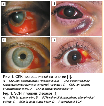 Рис. 1. СКК при различной патологии [1]. А — СКК при артериальной гипертензии, B — СКК с орбитальным кровоизлиянием после физической нагрузки, C — СКК при травме от контактных линз, D — СКК в стадии рассасывания Fig. 1. SCH in various diseases [1]. A — SC