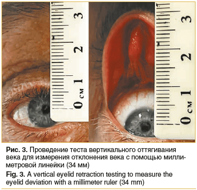 Рис. 3. Проведение теста вертикального оттягивания века для измерения отклонения века с помощью миллиметровой линейки (34 мм) Fig. 3. A vertical eyelid retraction testing to measure the eyelid deviation with a millimeter ruler (34 mm)