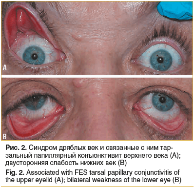 Рис. 2. Синдром дряблых век и связанные с ним тарзальный папиллярный конъюнктивит верхнего века (А); двусторонняя слабость нижних век (В) Fig. 2. Associated with FES tarsal papillary conjunctivitis of the upper eyelid (А); bilateral weakness of the lower 