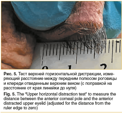 Рис. 5. Тест верхней горизонтальной дистракции, измеряющий расстояние между передним полюсом роговицы и кпереди отведенным верхним веком (с поправкой на расстояние от края линейки до нуля) Fig. 5. The “Upper horizontal distraction test” to measure the dis