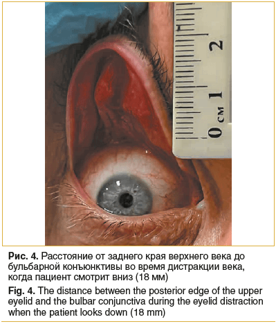 Рис. 4. Расстояние от заднего края верхнего века до бульбарной конъюнктивы во время дистракции века, когда пациент смотрит вниз (18 мм) Fig. 4. The distance between the posterior edge of the upper eyelid and the bulbar conjunctiva during the eyelid distra