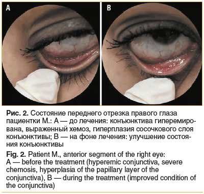 Рис. 2. Состояние переднего отрезка правого глаза пациентки М.: А — до лечения: конъюнктива гиперемирована, выраженный хемоз, гиперплазия сосочкового слоя конъюнктивы; В — на фоне лечения: улучшение состояния конъюнктивы Fig. 2. Patient M., anterior segme
