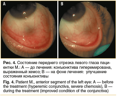 Рис. 4. Состояние переднего отрезка левого глаза пациентки М.: А — до лечения: конъюнктива гиперемирована, выраженный хемоз; В — на фоне лечения: улучшение состояния конъюнктивы Fig. 4. Patient M., anterior segment of the left eye: A — before the treatmen