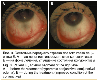 Рис. 3. Состояние переднего отрезка правого глаза пациентки E. А — до лечения: гиперемия, отек конъюнктивы; В — на фоне лечения: улучшение состояния конъюнктивы Fig. 3. Patient E., anterior segment of the right eye: A — before the treatment (hyperemic con
