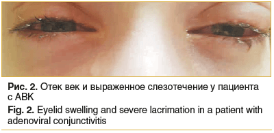 Рис. 2. Отек век и выраженное слезотечение у пациента с АВК Fig. 2. Eyelid swelling and severe lacrimation in a patient with adenoviral conjunctivitis