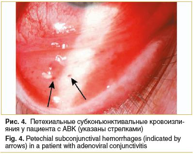 Рис. 4. Петехиальные субконъюнктивальные кровоизлияния у пациента с АВК (указаны стрелками) Fig. 4. Petechial subconjunctival hemorrhages (indicated by arrows) in a patient with adenoviral conjunctivitis