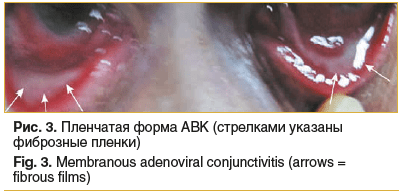 Рис. 3. Пленчатая форма АВК (стрелками указаны фиброзные пленки) Fig. 3. Membranous adenoviral conjunctivitis (arrows = fibrous films)