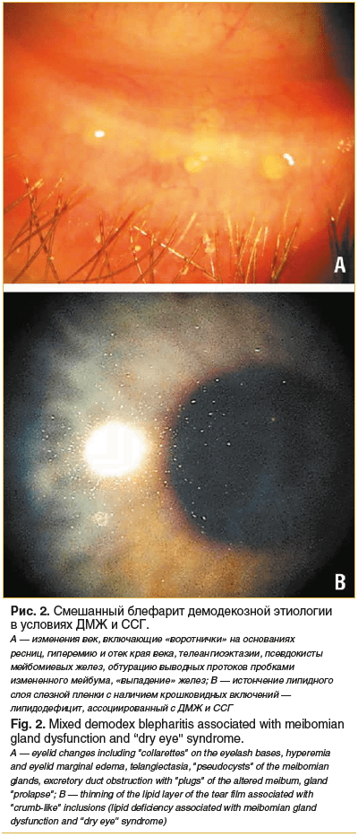 Рис. 2. Смешанный блефарит демодекозной этиологии в условиях ДМЖ и ССГ. A — изменения век, включающие «воротнички» на основаниях ресниц, гиперемию и отек края века, телеангиоэктазии, псевдокисты мейбомиевых желез, обтурацию выводных протоков пробками изме