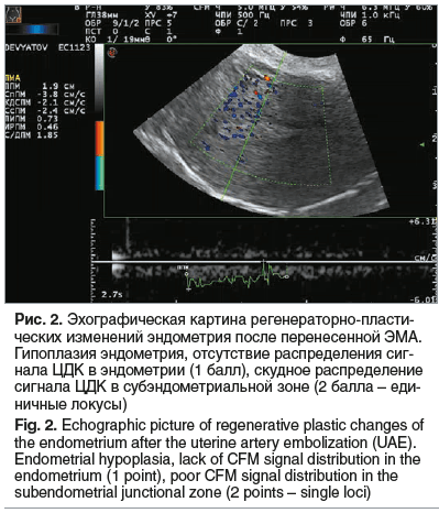 Рис. 2. Эхографическая картина регенераторно-пласти- ческих изменений эндометрия после перенесенной ЭМА. Гипоплазия эндометрия, отсутствие распределения сиг- нала ЦДК в эндометрии (1 балл), скудное распределение сигнала ЦДК в субэндометриальной зоне (2 ба