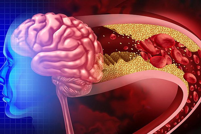 Neurology: ранние признаки проблем с сердцем связаны с уменьшением объема