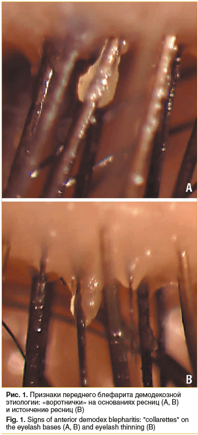 Рис. 1. Признаки переднего блефарита демодекозной этиологии: «воротнички» на основаниях ресниц (А, В) и истончение ресниц (В) Fig. 1. Signs of anterior demodex blepharitis: 