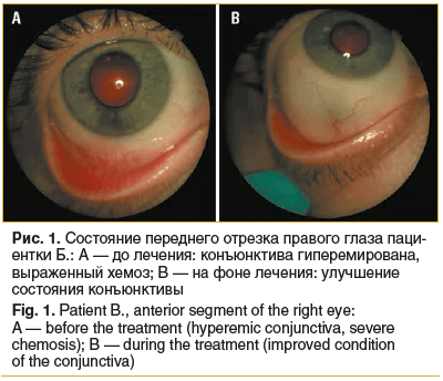 Рис. 1. Состояние переднего отрезка правого глаза пациентки Б.: A — до лечения: конъюнктива гиперемирована, выраженный хемоз; B — на фоне лечения: улучшение состояния конъюнктивы Fig. 1. Patient B., anterior segment of the right eye: A — before the treatm