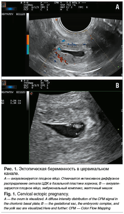 Рис. 1. Эктопическая беременность в цервикальном канале. А — визуализируется плодное яйцо. Отмечается интенсивное диффузное распределение сигнала ЦДК в базальной пластине хориона; В — визуали- зируются плодное яйцо, эмбриональный комплекс, желточный мешок