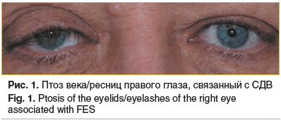 Рис. 1. Птоз века/ресниц правого глаза, связанный с СДВ Fig. 1. Ptosis of the eyelids/eyelashes of the right eye associated with FES