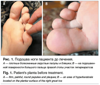 Рис. 1. Подошва ноги пациента до лечения. А — плотные болезненные округлые папулы и бляшки; В — на подошвен- ной поверхности большого пальца правой стопы участок гиперкератоза Fig. 1. Patient's planta before treatment. A — firm, painful, round papules and