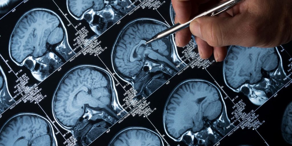 Российские исследователи нашли способ восстановления когнитивных функций при деменции