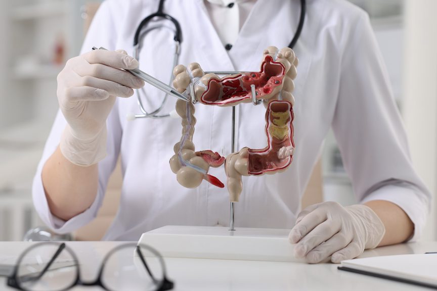 Найдена возможная причина рака кишечника у молодых: виноваты бактерии