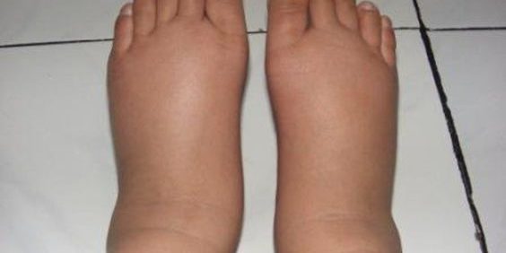 Неочевидные причины появления отеков — Медицина 2.0