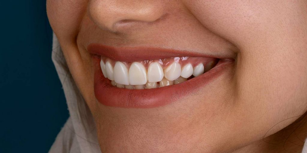 Россиян предупредили об опасности наращивания зубов гель-лаком