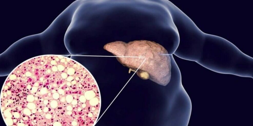 Диабет связан со значительно повышенным риском жировой дистрофии печени