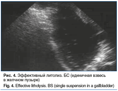 Рис. 4. Эффективный литолиз. БС (единичная взвесь в желчном пузыре) Fig. 4. Effective litholysis. BS (single suspension in a gallbladder)