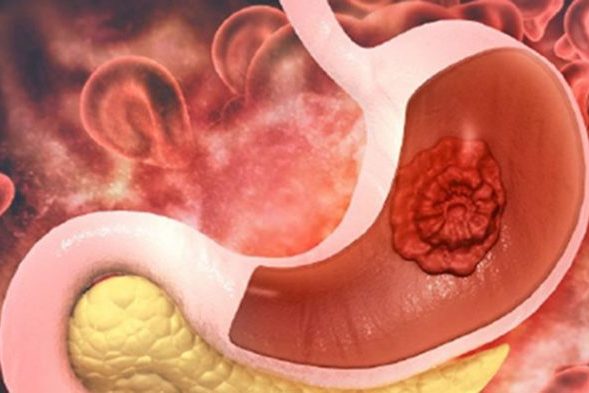 Большинство случаев рака желудка связаны с распространенными бактериями