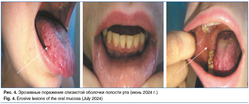 Рис. 4. Эрозивные поражения слизистой оболочки полости рта (июнь 2024 г.) Fig. 4. Erosive lesions of the oral mucosa (July 2024)
