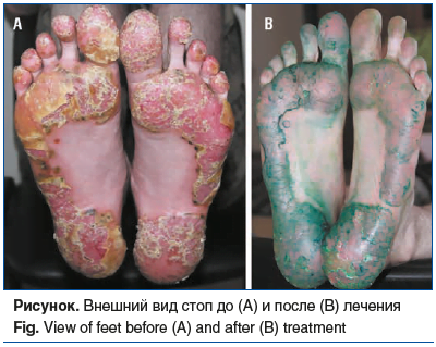 Рисyнок. Внешний вид стоп до (A) и после (B) лечения Fig. View of feet before (A) and after (B) treatment