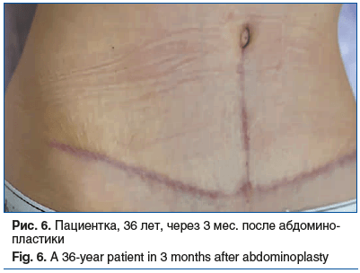 Рис. 6. Пациентка, 36 лет, через 3 мес. после абдомино- пластики Fig. 6. A 36-year patient in 3 months after abdominoplasty