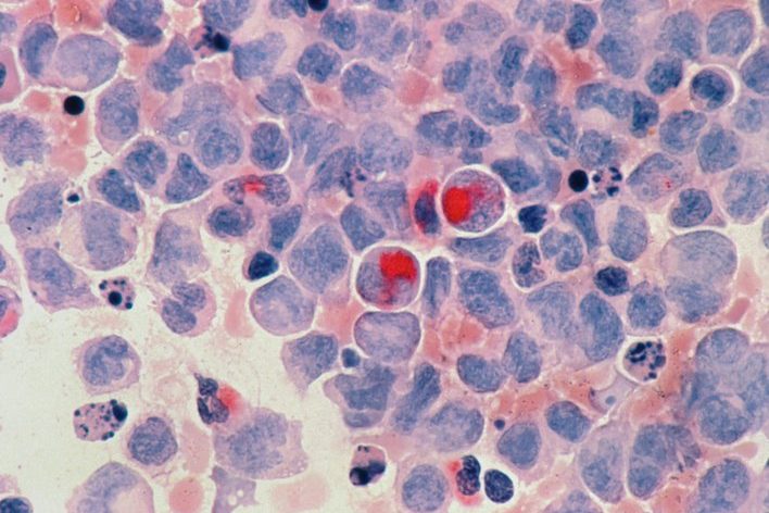 COVID-19 и грипп могут «разбудить» спящие раковые клетки и вызвать