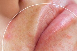 Препараты для лечения угрей — абсолютные рекордсмены натуральной динамики продаж на розничном рынке